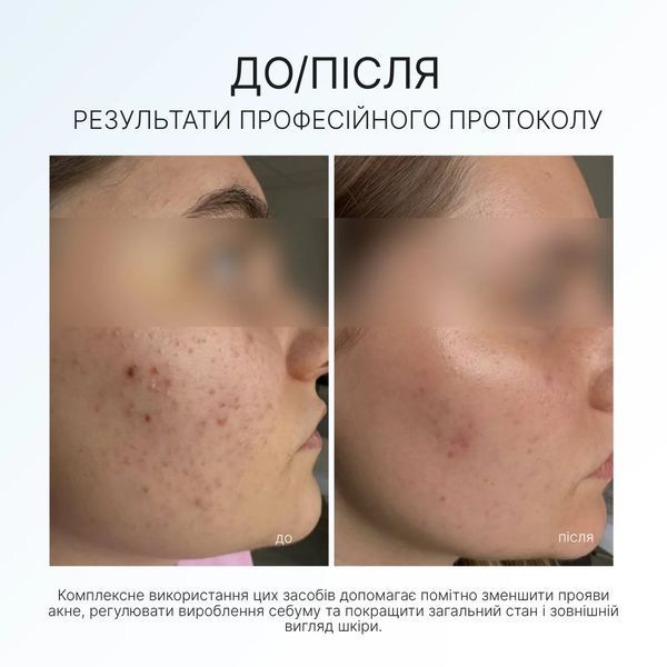 INTENSE CREAM GEL Інтенсивний дерматоконтроль крем-гель 50ml 09752884 фото
